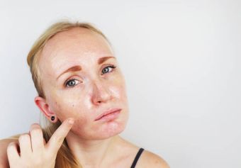 Home Remedies For Oily Skin That Work Well