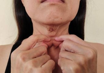 How To Treat Neck Wrinkles? 6 Effective Ways to Treat Them